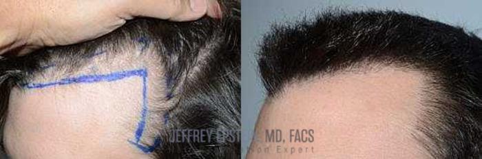 Before & After Hair Transplants For Men Case 116 View 1 View in Miami, FL