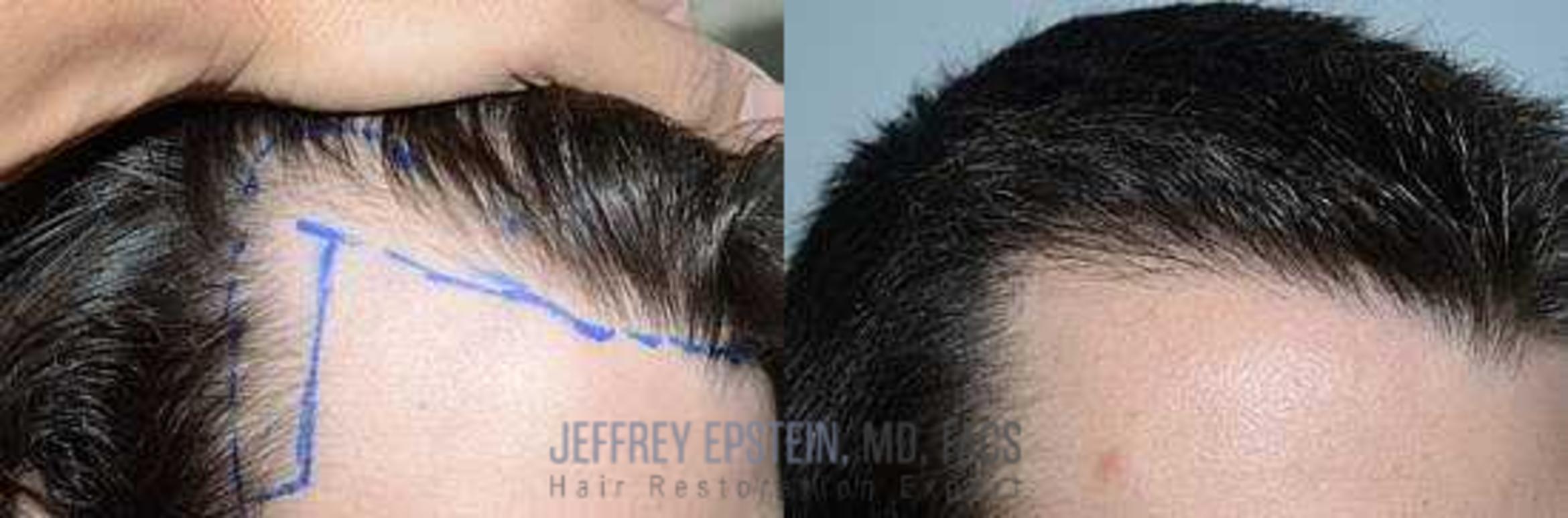 Before & After Hair Transplants For Men Case 116 View 2 View in Miami, FL