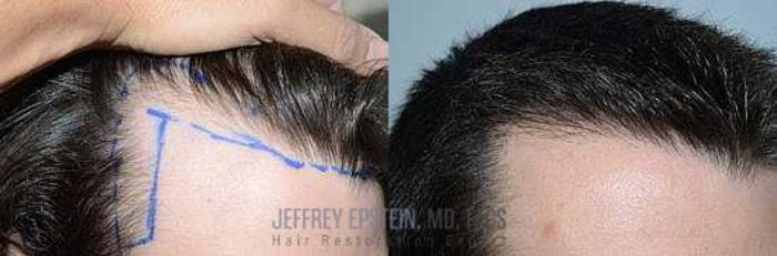 Before & After Hair Transplants For Men Case 116 View 2 View in Miami, FL