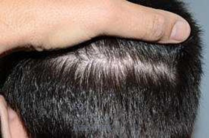 Before & After Hair Transplants For Men Case 116 View 3 View in Miami, FL