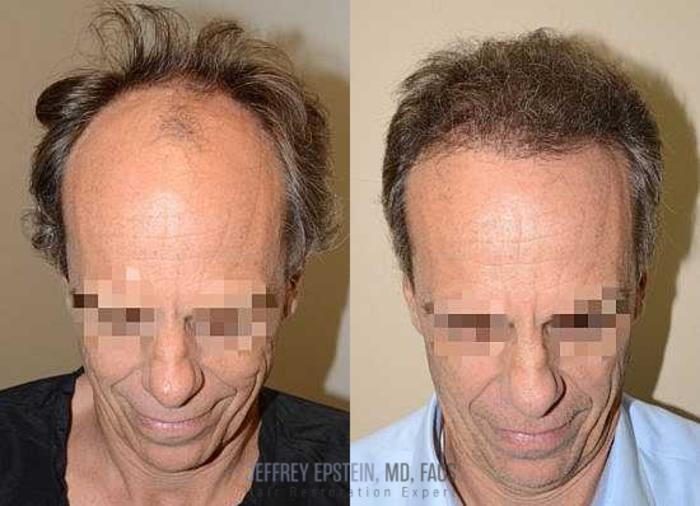 Before & After Hair Transplants For Men Case 117 View 1 View in Miami, FL