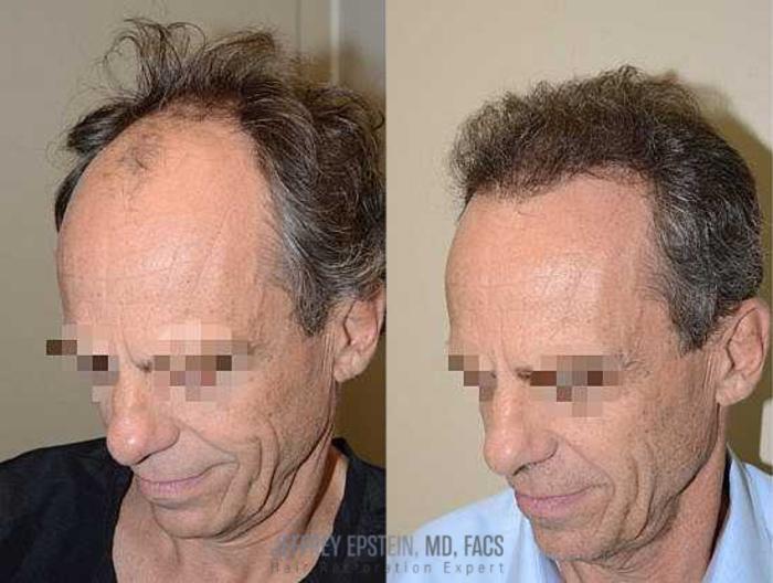 Before & After Hair Transplants For Men Case 117 View 2 View in Miami, FL