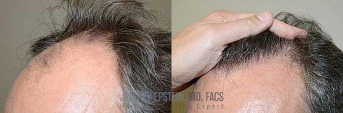 Before & After Hair Transplants For Men Case 117 View 3 View in Miami, FL