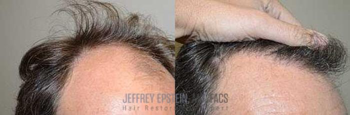 Before & After Hair Transplants For Men Case 117 View 4 View in Miami, FL