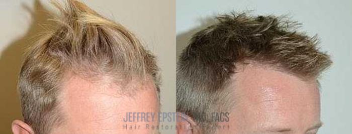 Before & After Hair Transplants For Men Case 118 View 1 View in Miami, FL