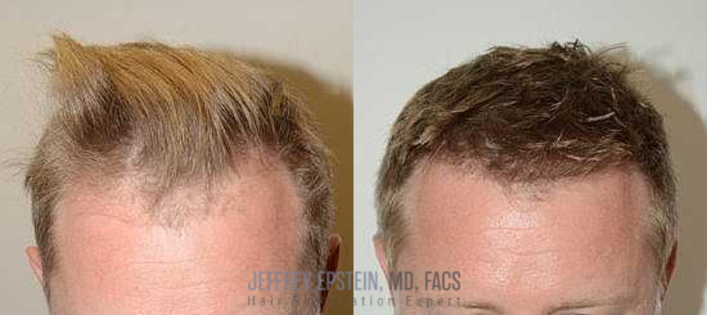 Before & After Hair Transplants For Men Case 118 View 2 View in Miami, FL
