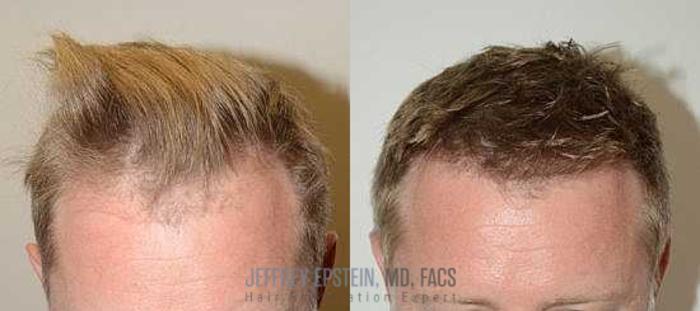 Before & After Hair Transplants For Men Case 118 View 2 View in Miami, FL