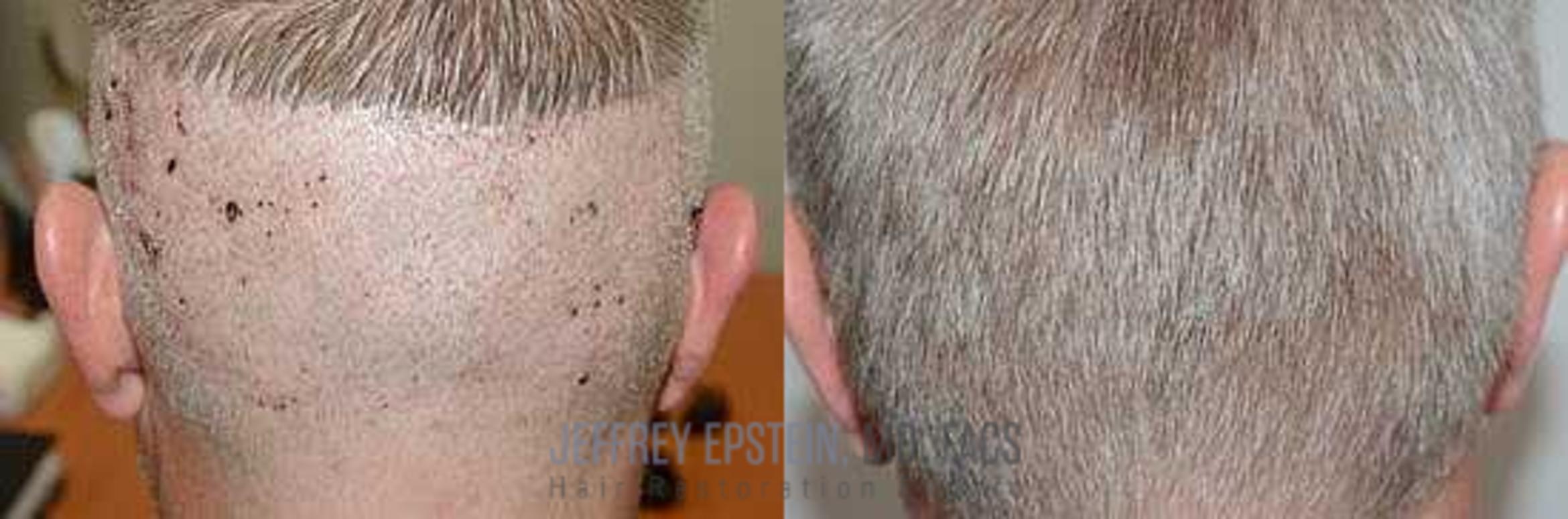 Before & After Hair Transplants For Men Case 118 View 3 View in Miami, FL
