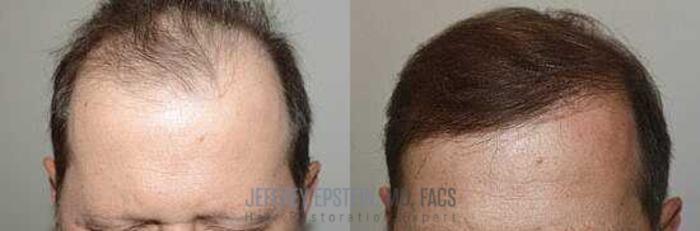Before & After Hair Transplants For Men Case 12 View 1 View in Miami, FL