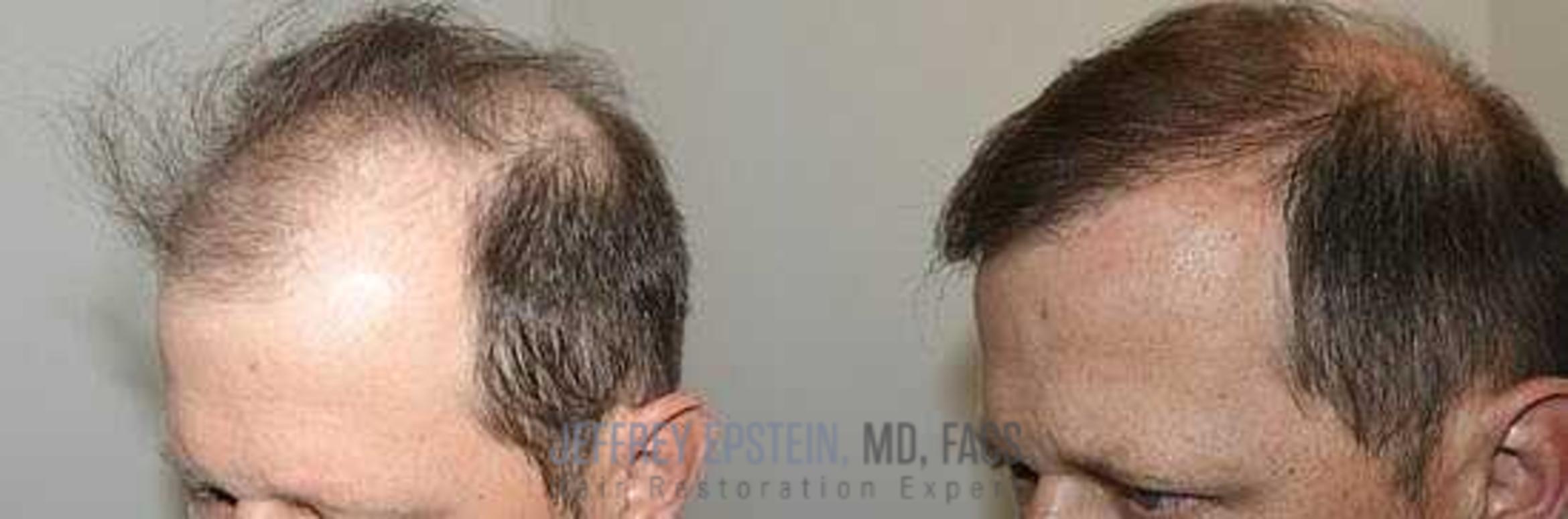 Before & After Hair Transplants For Men Case 12 View 2 View in Miami, FL