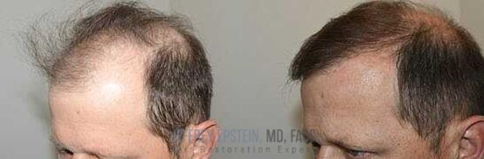 Before & After Hair Transplants For Men Case 12 View 2 View in Miami, FL