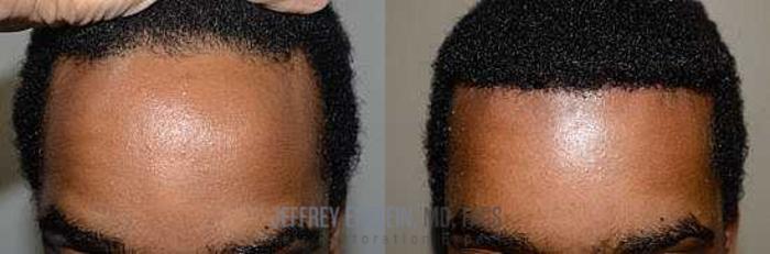Before & After Hair Transplants For Men Case 120 View 1 View in Miami, FL