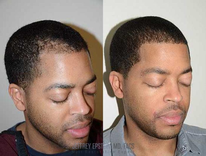 Before & After Hair Transplants For Men Case 121 View 1 View in Miami, FL