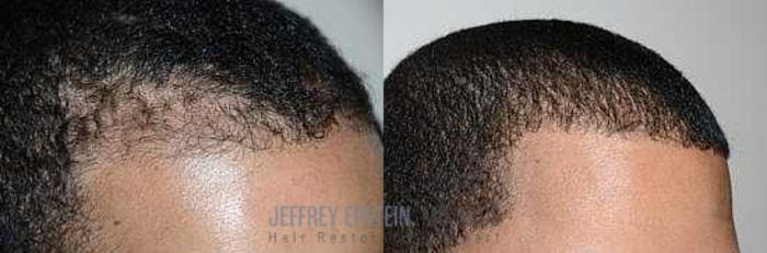 Before & After Hair Transplants For Men Case 121 View 2 View in Miami, FL
