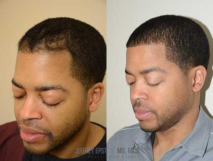 Before & After Hair Transplants For Men Case 121 View 3 View in Miami, FL