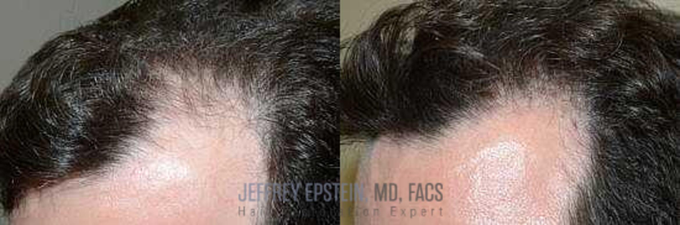 Before & After Hair Transplants For Men Case 122 View 1 View in Miami, FL