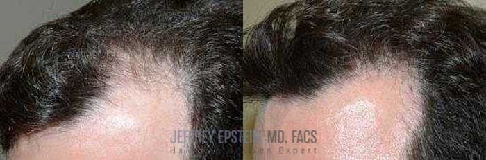 Before & After Hair Transplants For Men Case 122 View 1 View in Miami, FL