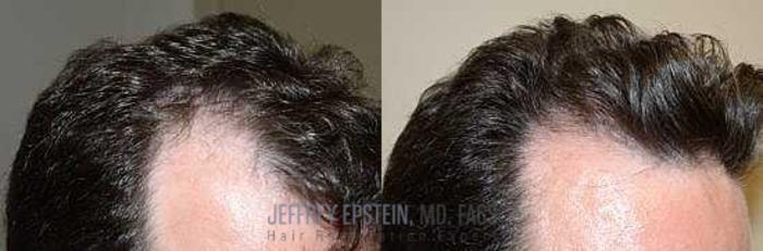 Before & After Hair Transplants For Men Case 122 View 2 View in Miami, FL