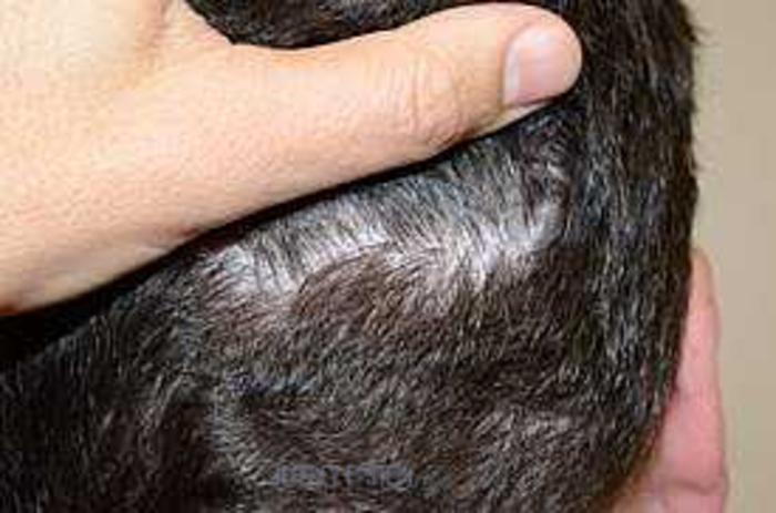 Before & After Hair Transplants For Men Case 122 View 3 View in Miami, FL