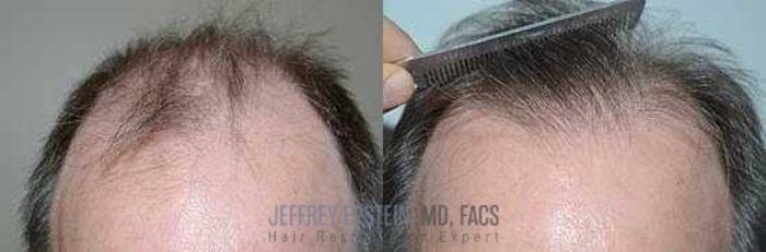 Before & After Hair Transplants For Men Case 123 View 1 View in Miami, FL