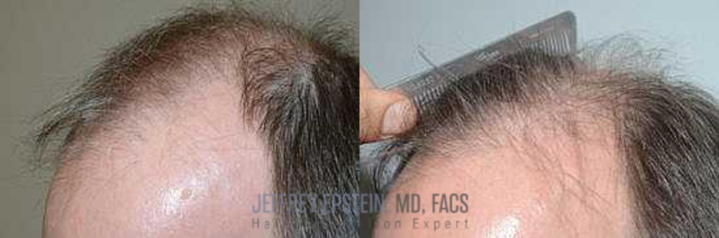 Before & After Hair Transplants For Men Case 123 View 2 View in Miami, FL