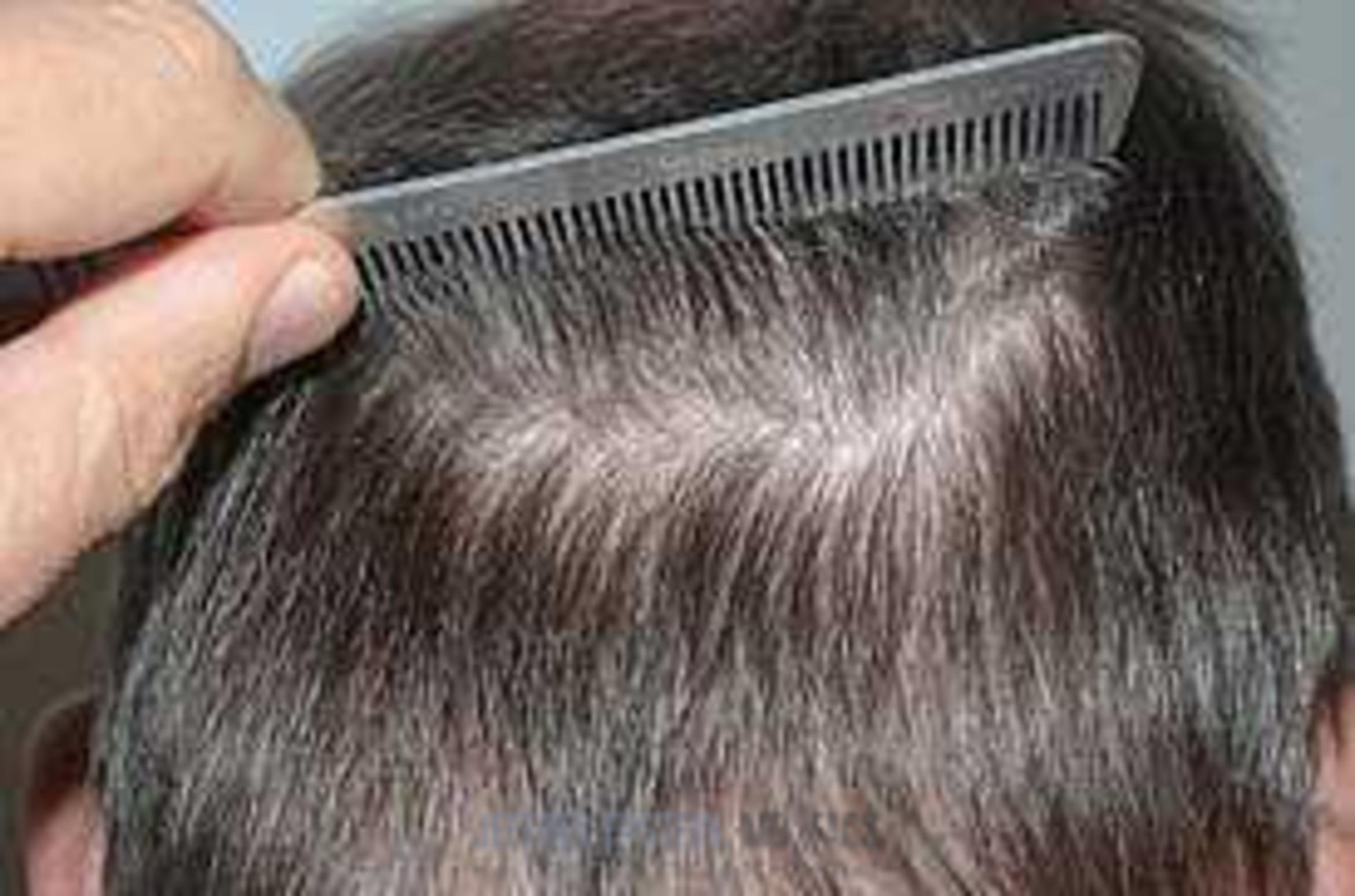 Before & After Hair Transplants For Men Case 123 View 3 View in Miami, FL