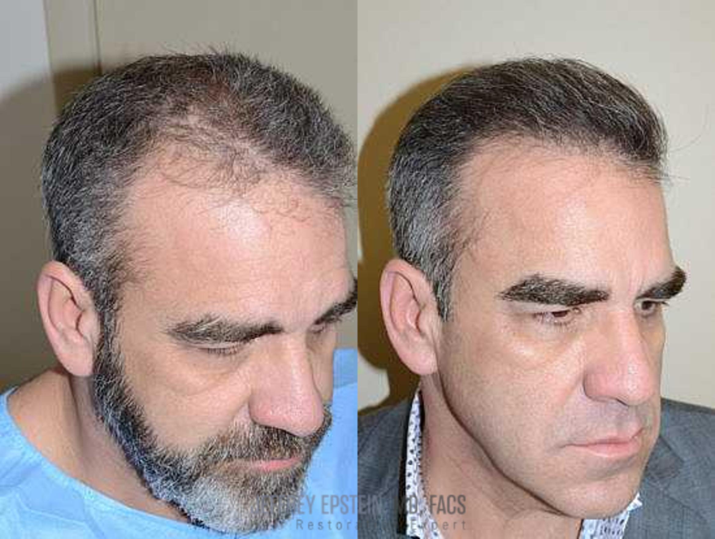 Before & After Hair Transplants For Men Case 124 View 1 View in Miami, FL