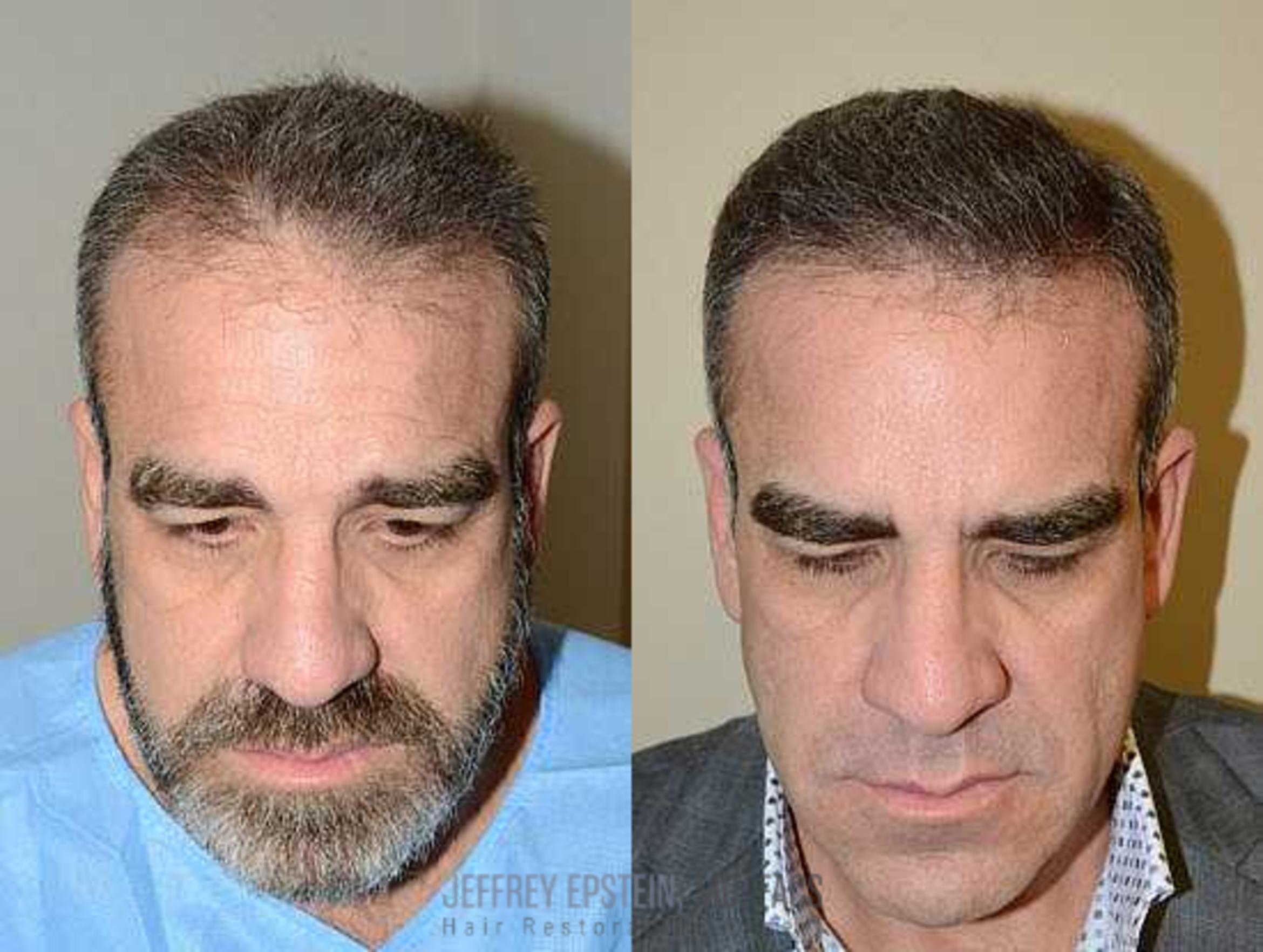 Before & After Hair Transplants For Men Case 124 View 2 View in Miami, FL