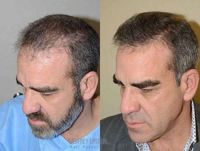 Before & After Hair Transplants For Men Case 124 View 3 View in Miami, FL