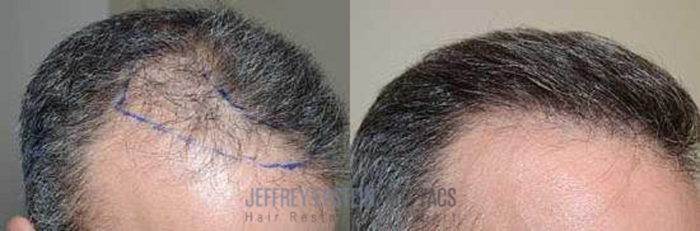 Before & After Hair Transplants For Men Case 124 View 4 View in Miami, FL