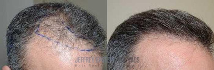 Before & After Hair Transplants For Men Case 124 View 4 View in Miami, FL