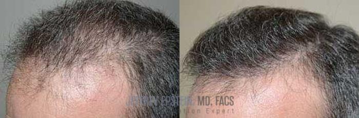 Before & After Hair Transplants For Men Case 124 View 5 View in Miami, FL