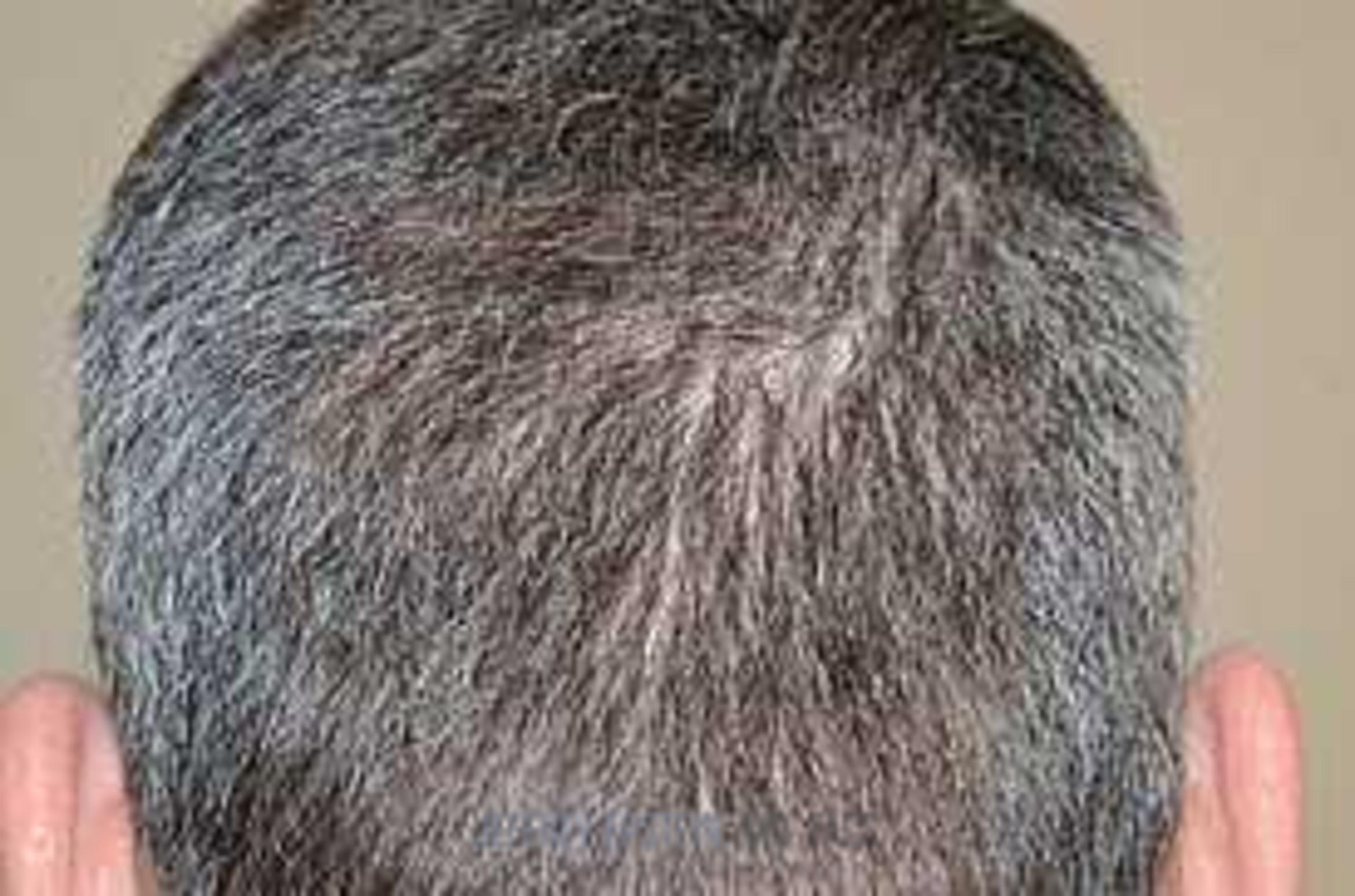 Before & After Hair Transplants For Men Case 124 View 6 View in Miami, FL