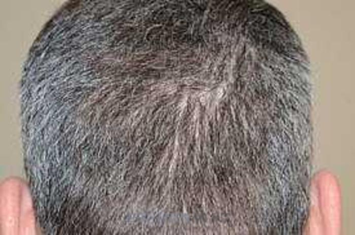 Before & After Hair Transplants For Men Case 124 View 6 View in Miami, FL