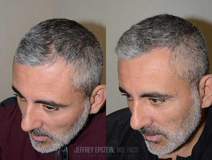 Before & After Hair Transplants For Men Case 127 View 1 View in Miami, FL