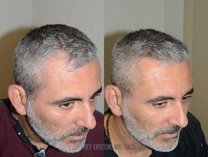 Before & After Hair Transplants For Men Case 127 View 2 View in Miami, FL