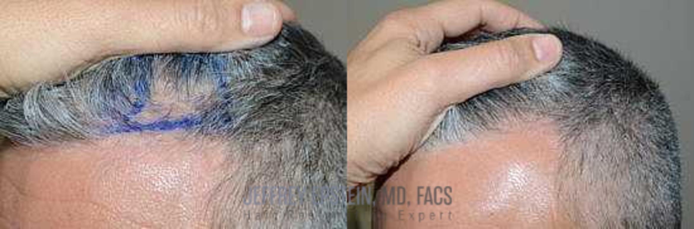 Before & After Hair Transplants For Men Case 127 View 3 View in Miami, FL