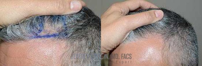 Before & After Hair Transplants For Men Case 127 View 3 View in Miami, FL