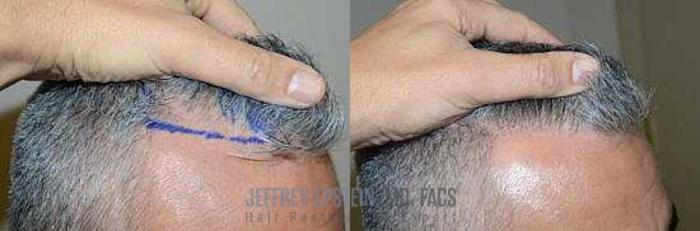 Before & After Hair Transplants For Men Case 127 View 4 View in Miami, FL