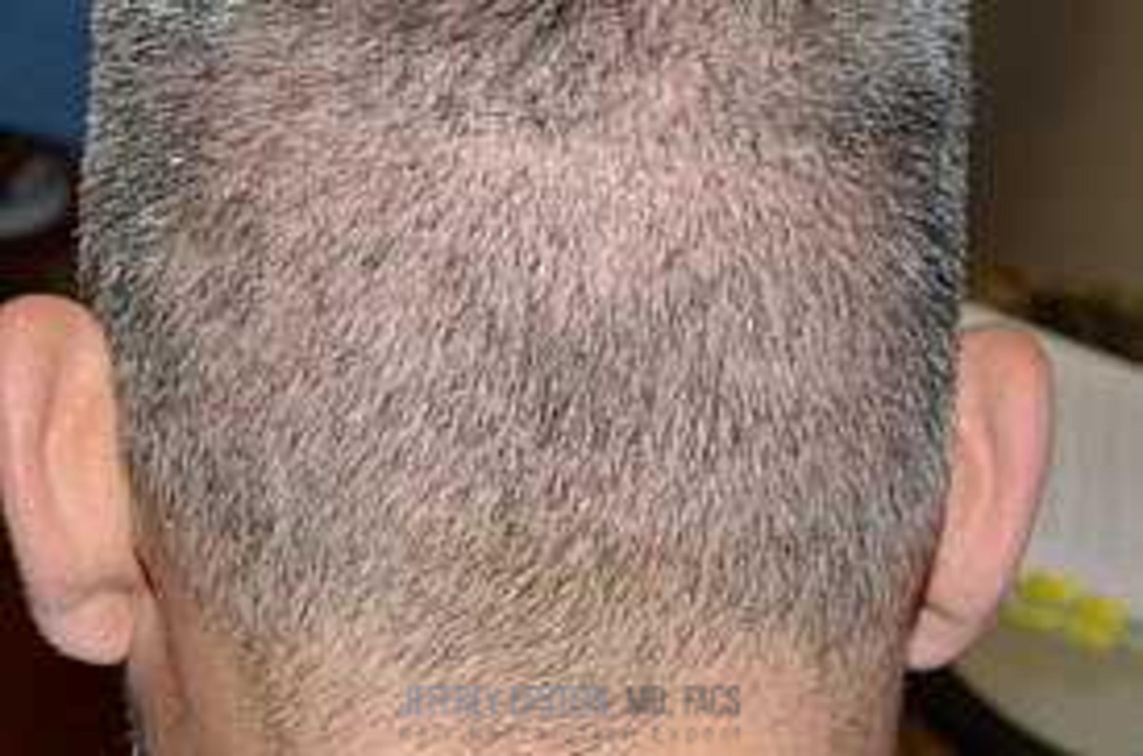 Before & After Hair Transplants For Men Case 127 View 5 View in Miami, FL