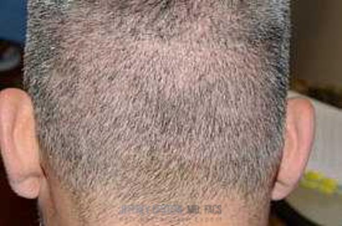 Before & After Hair Transplants For Men Case 127 View 5 View in Miami, FL