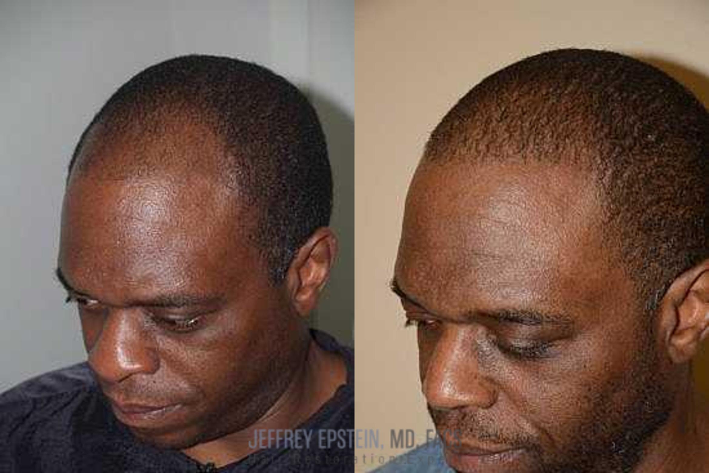 Before & After Hair Transplants For Men Case 128 View 1 View in Miami, FL