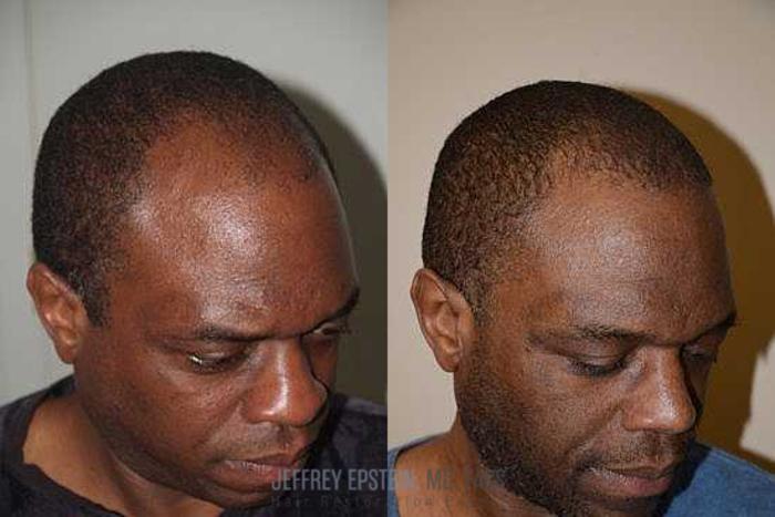 Before & After Hair Transplants For Men Case 128 View 2 View in Miami, FL