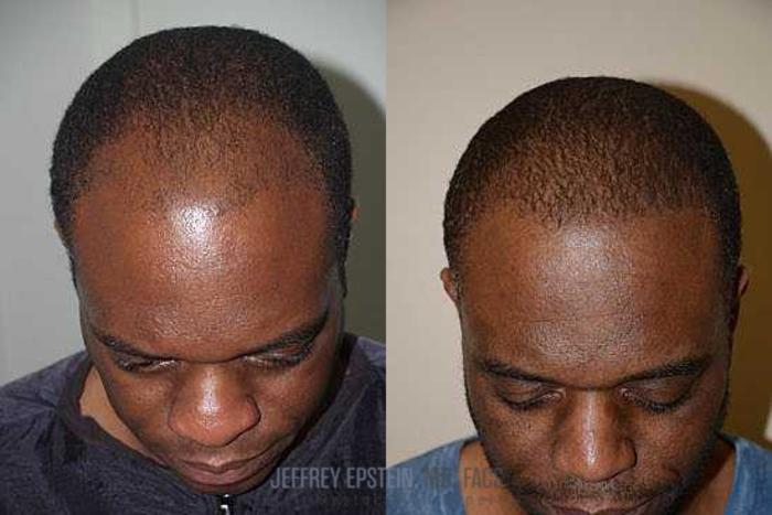 Before & After Hair Transplants For Men Case 128 View 3 View in Miami, FL