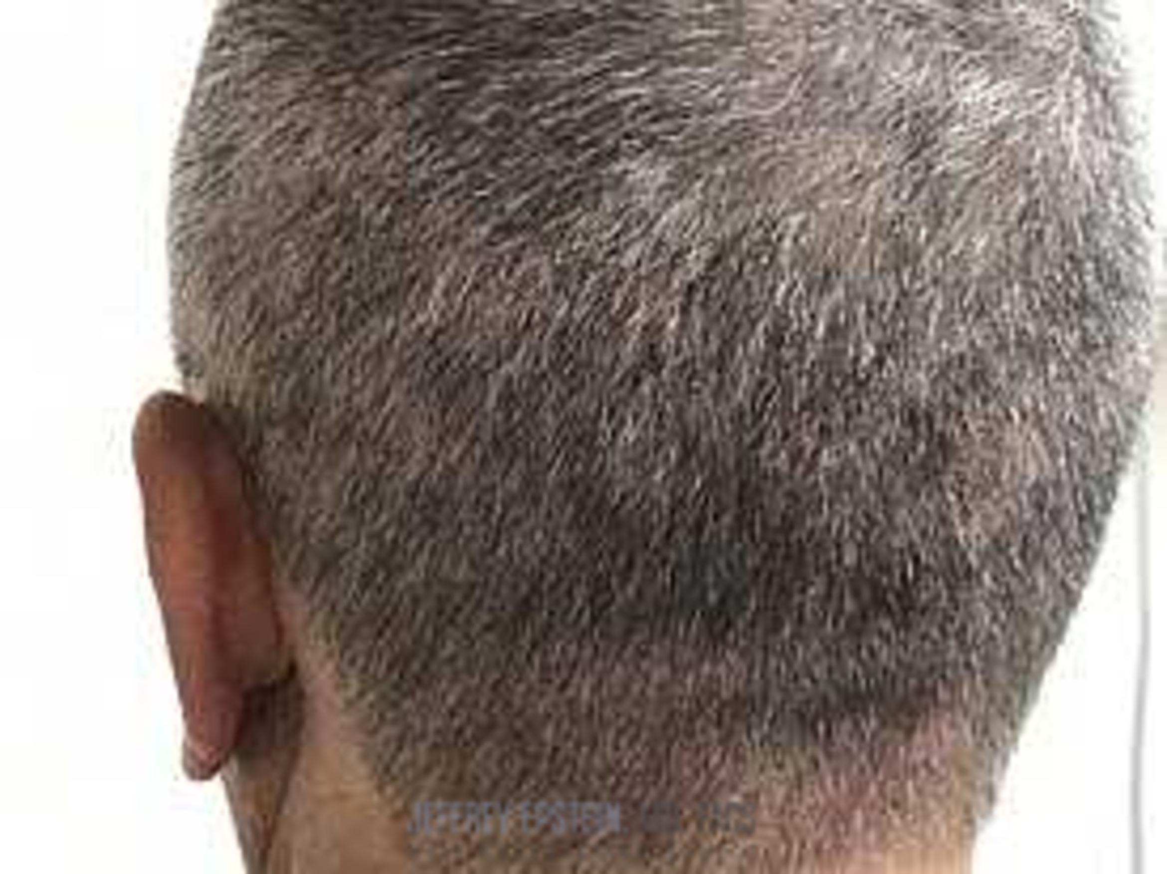 Before & After Hair Transplants For Men Case 129 View 1 View in Miami, FL