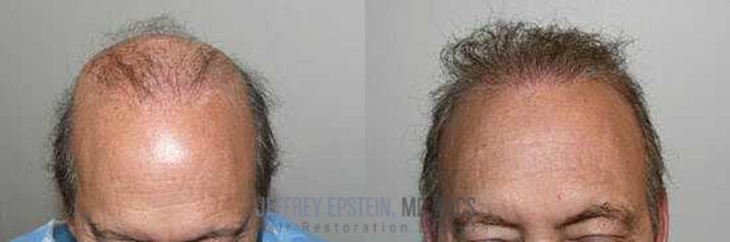 Before & After Hair Transplants For Men Case 13 View 1 View in Miami, FL