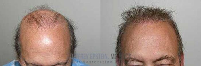 Before & After Hair Transplants For Men Case 13 View 1 View in Miami, FL