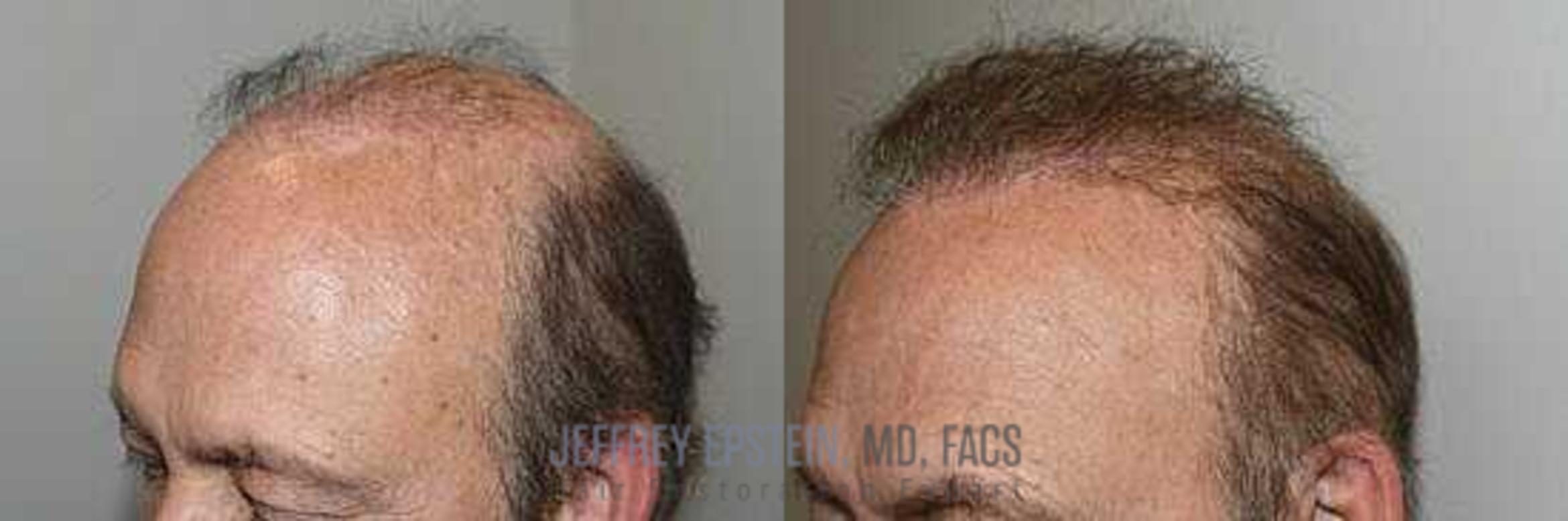 Before & After Hair Transplants For Men Case 13 View 2 View in Miami, FL