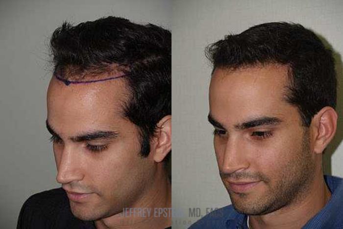 Before & After Hair Transplants For Men Case 132 View 1 View in Miami, FL