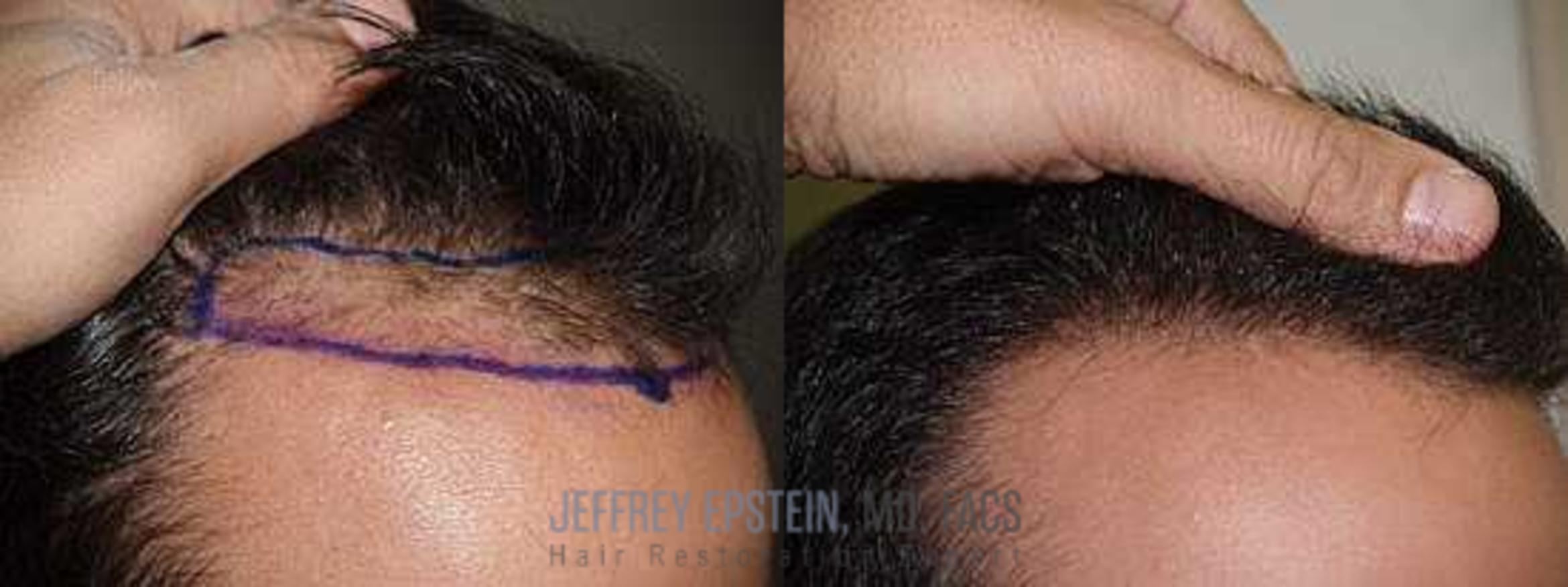 Before & After Hair Transplants For Men Case 132 View 2 View in Miami, FL